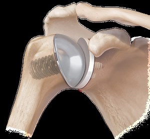 Schulterendoprothetik