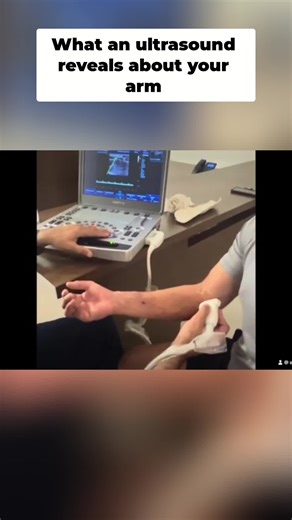 Post-accident update: Your arm's arterial pulse levels are key to recovery. Many feel recovery is slow; what's your experience? #LosCabos #CaboSanLucas #SanJoseDelCabo #BajaCaliforniaSur #MexicoExpats #ExpatsInMexico #LosCabosLife #HealthUpdate #RecoveryJourney #PatientCare #MedicalImaging #ArteryHealth #BajaLife #ExpatLiving