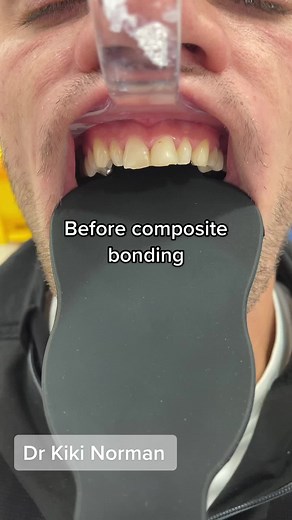 Composite Bonding Process Explained by Dr. Kiki Norman