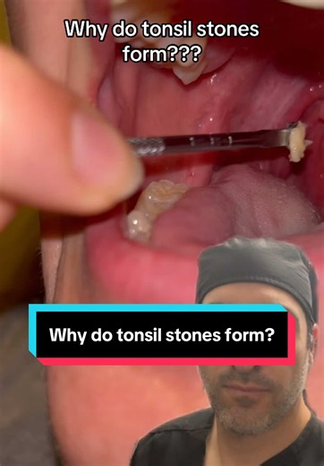 Why do tonsil stones form? #tonsilstones #tonsil #tonsillectomy | tonsilstones