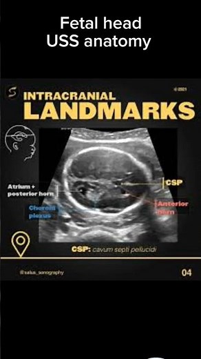 Fetal head ultrasound anatomy.
