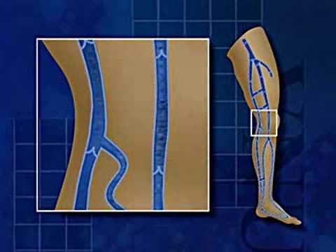 Venous Reflux Education Video
