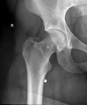 HOW TO DO A HIP ARTHROGRAM