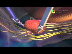 Patienteninformation da Vinci Prostatektomie