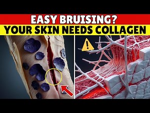 Skin Tears Like Paper? Why You Bruise So Easily & How to Fix It