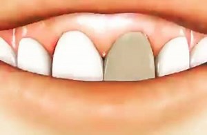 79K views · 667 reactions | Root Canal Therapy with Internal Tooth Bleaching for Discoloured Tooth - Superb technique | Dr.Sreenath S | Facebook