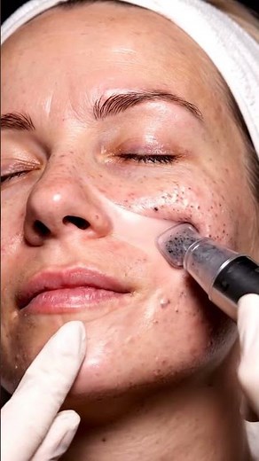 “Most Satisfying Full Face Extraction You’ll Ever See 😱”Oddly Satisfying Blackhead Removal