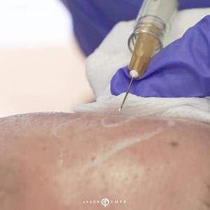 How to improve acne scars using dermal fillers