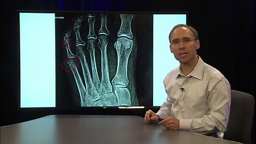 Toe Breaks (Fractures) - Is there anything I can do?