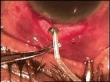 Neovascular glaucoma surgery • Video • MEDtube.net