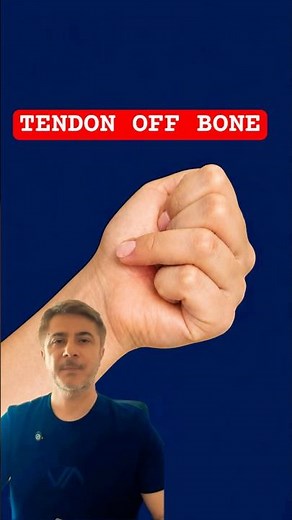 This Finger Tendon Snapped! #orthopedics #sports #doctor #medical #handpain #jerseyfinger