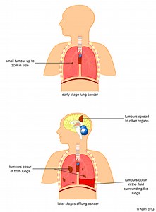 the effect of smoking