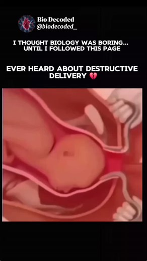 Bio Decoded on Instagram: "1️⃣ Done only in extreme emergencies ⚠️ When the baby cannot be delivered normally and both mother & baby are in danger, doctors may use destructive delivery as a life-saving step. 2️⃣ Used when C-section is impossible 🚫🔪 If a C-section cannot be performed (late arrival, lack of resources, or severe complications), this method is considered. 3️⃣ Involves surgical reduction of fetal size ✂️ Doctors may reduce the size of the fetus (like craniotomy) to make vaginal del