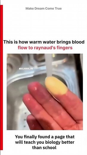 💦 warm water brings 🩸 blood flow to raynaud's fingers ☝️ | MDCT