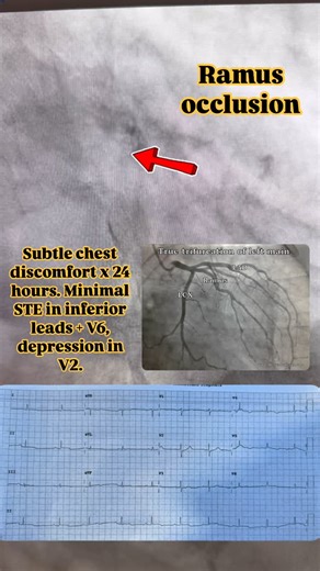 The Prehospitalist on Instagram: "The ramus intermedius is a variant coronary artery only present in 15-30% of the population. Super subtle presentation in this patient with an RI occlusion🫀 📚: Sarıçam E, Erdol MA, Bozkurt E, Ilkay E, Cantekin ÖF. New ECG Algorithm for the Prediction of Culprit Vessel in Acute Myocardial Infarction Involving Lateral Part of the Ventricle: Ilkay Classification. Int J Gen Med. 2023 Jun 22;16:2643-2651. doi: 10.2147/IJGM.S416376. PMID: 37377781; PMCID: PMC1029260