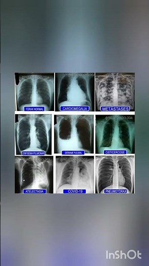 “Chest X-ray Reveals the Hidden Story Inside Your Lungs 🫁✨”