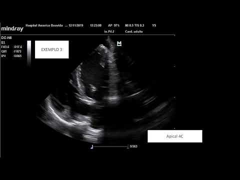 Endocardite Infecciosa / Infective Endocarditis - vegetations on echocardiography