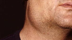 Mumps outbreak near University of Florida