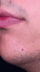 Before & After Surgical Mole Removal