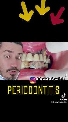 Periodontitis 😬 #periodontitis #gingivitis #sarrodental #dentista