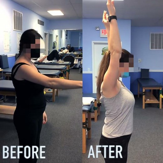 Right Collarbone Fracture Progress