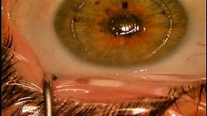 Explantation of Raindrop® Corneal Shape-Changing Hydrogel Inlay (ReVision Optics) - Eyetube