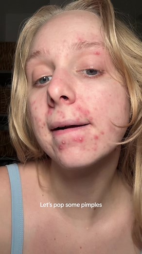 Effective Acne Treatment: Pimple Pop Extractions