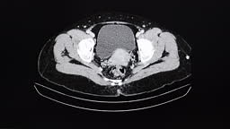 CT cine scan of an abdomen of a patient with internal multi-septate...