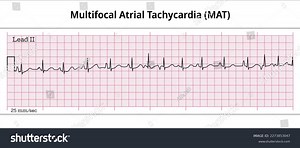 Multifocal Atrial Tachycardia Mat 8 Second Stock Vector (Royalty Free) 2273853047 | Shutterstock