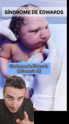 Edwards Syndrome. #survival #curiosities #didyouknow