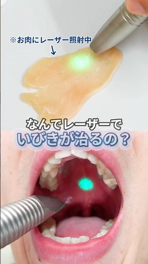 ＼パルスサーミアの原理をご紹介💡／ #いびき改善#いびき治療 #いびき#睡眠時無呼吸症候群#パルスサーミア