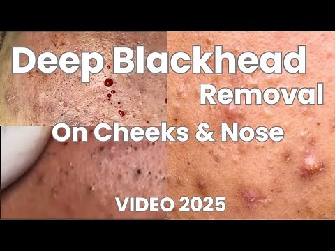 Blackhead Removal On Cheek and Nose |Pimple Spa