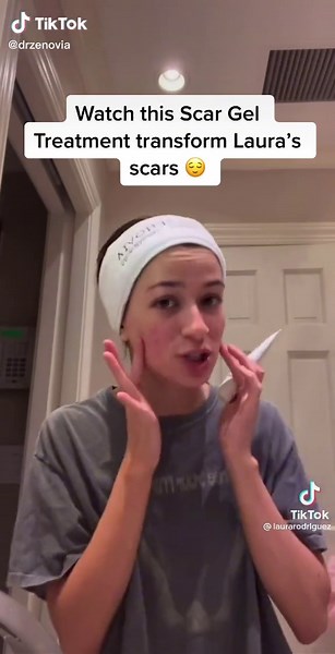 Acne Scar Treatment: Before & After Results