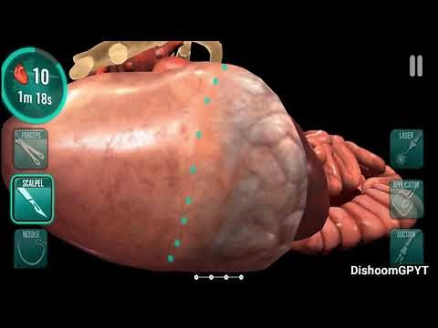 Operate Now: Hospital (by Spil Games) "ONCOLOGICAL SURGERY - LUNG" - Android/iOS gameplay #5