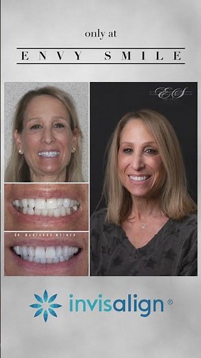 Another beautiful smile transformation done at Envy Smile in Brooklyn N.Y Done with Invisalign!