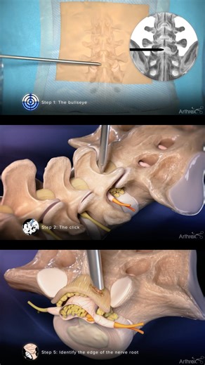 Arthrex Spine on Instagram: "This animation demonstrates the steps of the interlaminar approach for a discectomy procedure using the SynergyID™ imaging system and a spine-specific endoscope. It also highlights the unique WishBone™ instrument handle, which is designed for improved ergonomics, and FlexTip electrosurgery probe. Learn more at the link in bio. #Arthrex #ArthrexSpine #EndoscopicSpine"