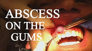 ABSCESS ON THE GUMS. TOP 10 (ABSCESS,PUS,BOIL) "NASTY PIMPLES"