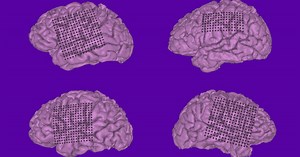 Neuroprosthetics: Doctors Decode Human Speech From Brain Signals