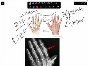 Heberden & Bouchard nodes l Osteoarthritis Fingers