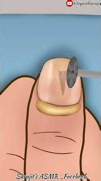 Remove_huge_splinter_from_thumb_finger_asmr_animation_viralvideo #asmrvideo #satisfying #animation