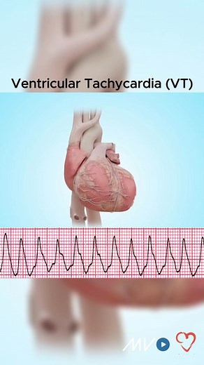 1.2M views · 17K reactions | Sleep Apnea & Arrhythmias Sleep apnea...