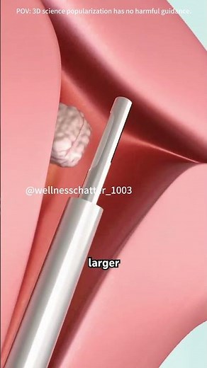 Hysteroscopy procedure (3D Animation) #3danimation #facts #surgery #science #aesthetic #anatomy