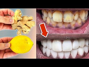 In just 2 MINUTES YELLOW dirty Teeth become Milky WHITE and Shiny🤯💥
