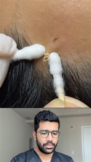 Comedone Extraction…. On the forehead #comedoneextraction #blackheads