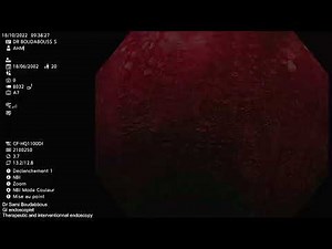 colon crohn disease screening colonoscopy