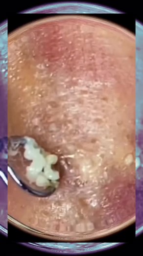 the pimple crusher su TikTok