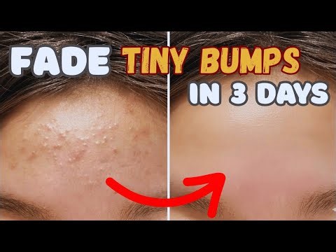 How to get rid of TINY BUMPs on face at home NATURALLY || Closed comodones & Fungal acne