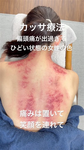 【偏頭痛の取れない女性にカッサ療法】