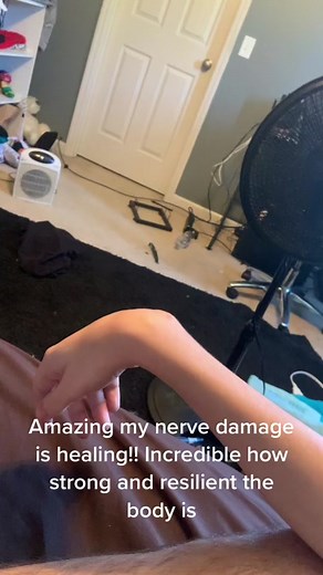 Never thought it would actually come back!! Not back yet but that’s an amazing sign that something’s happening #nervedamage #recovery #miracle