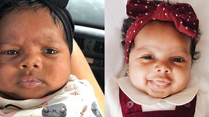 How to get rid of baby acne - Aseky   Co.